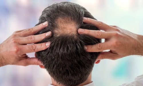 Mannen, ook voor jullie is het niet niets om je haar te zien dunnen. Na al die jaren met een volle haardos voel je je niet meer echt jezelf.