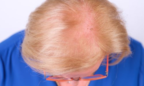 Overmatig haarverlies is vaak een signaal van je lichaam. Ontdek hier de 9 meest voorkomende oorzaken van haarverlies bij vrouwen.