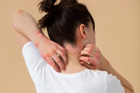 Tijdens het bezoek aan de dermatoloog kom je te weten dat je aan psoriasis lijdt. Voel je je erg onzeker door de psoriasis op je hoofdhuid?