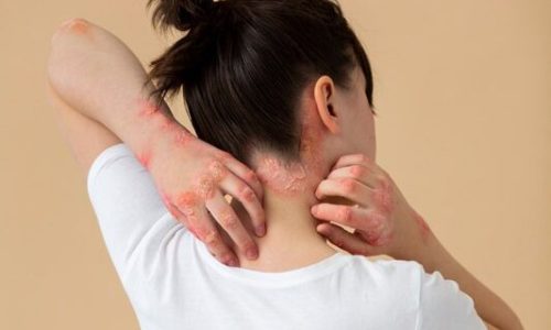 Tijdens het bezoek aan de dermatoloog kom je te weten dat je aan psoriasis lijdt. Voel je je erg onzeker door de psoriasis op je hoofdhuid?